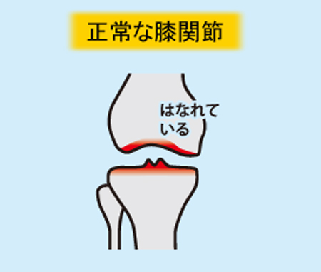 膝関節痛