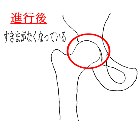 股関節末期