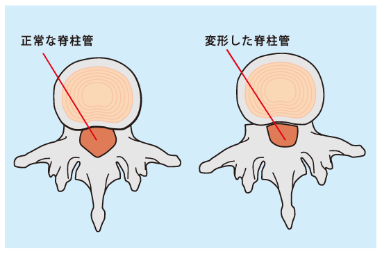 脊柱管狭窄症比較