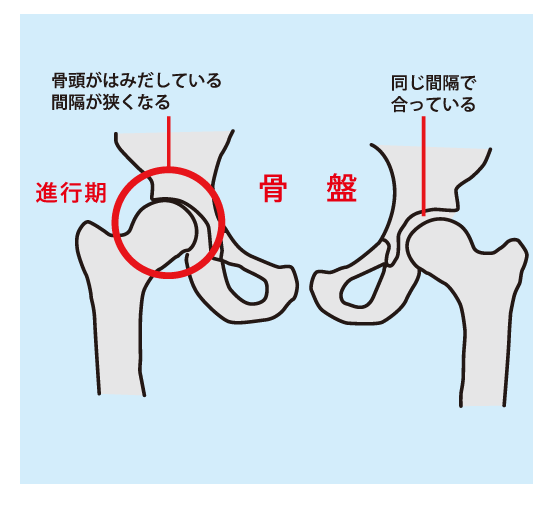 変形性股関節