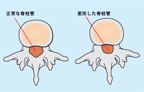 脊柱管狭窄症