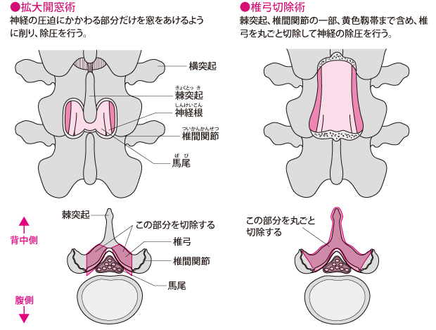 拡大開窓術