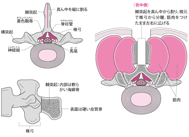 棘突起縦割式椎弓切除術