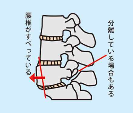 腰部すべり症