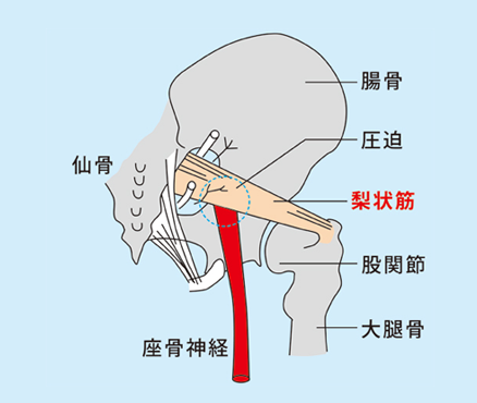 治療 坐骨 神経痛 坐骨神経痛の症状と治療法