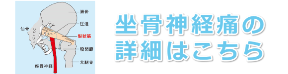 坐骨神経痛