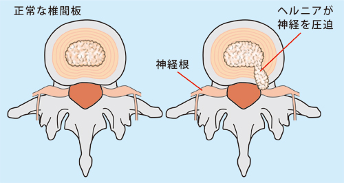 椎間板ヘルニア