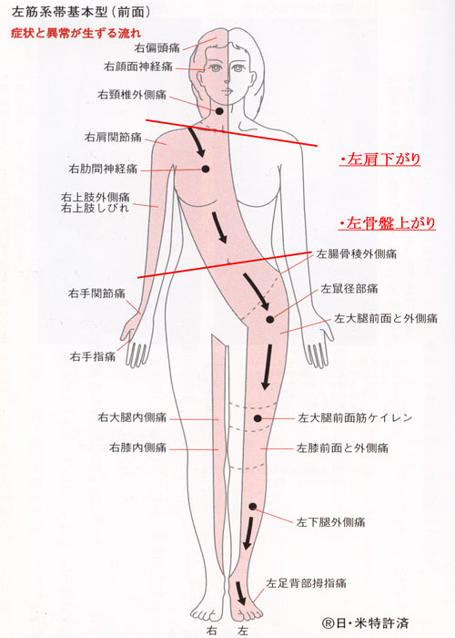 左筋系帯前