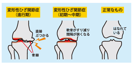 変形性膝関節痛