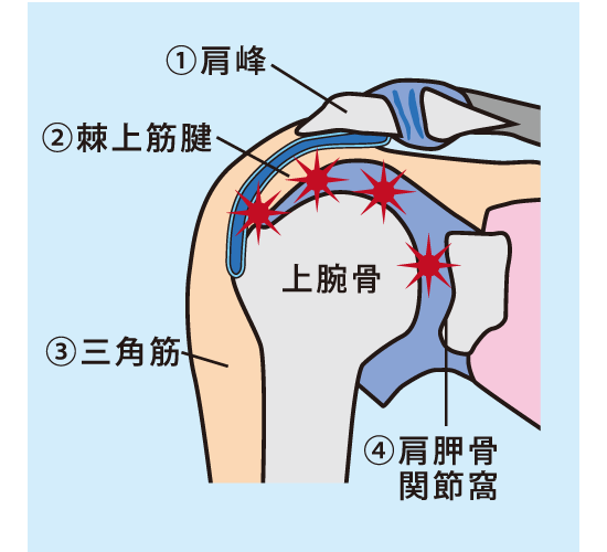 五十肩