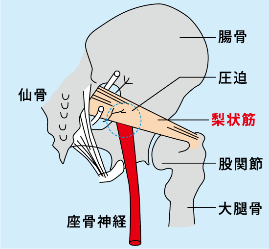 梨状筋症候群