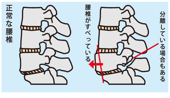 腰椎すべり症