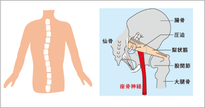 歪み骨盤